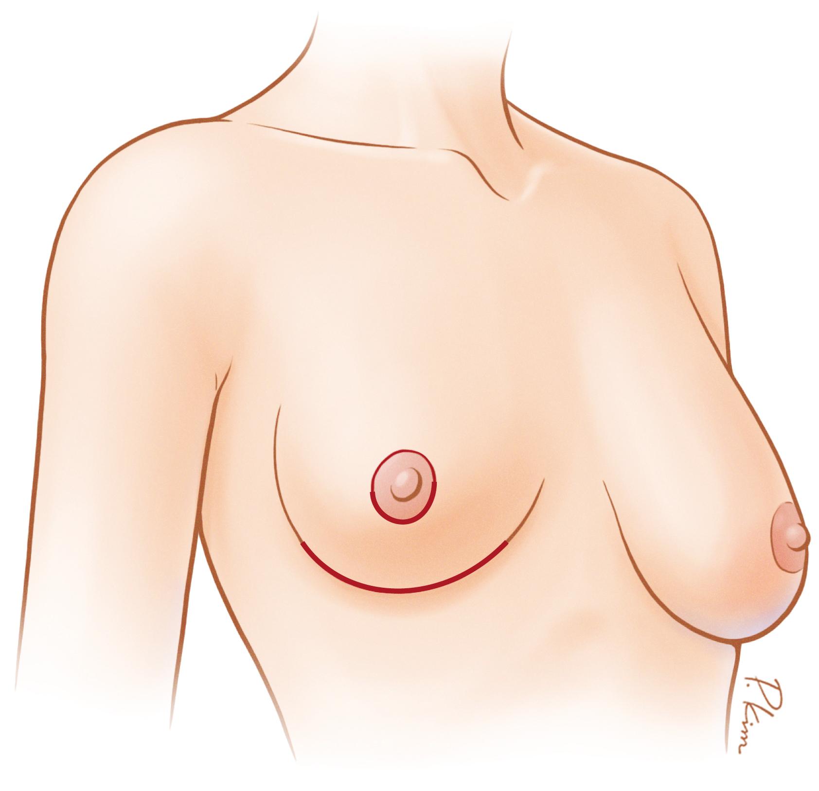 Fig. 25.1, Types of incision used for breast implants.