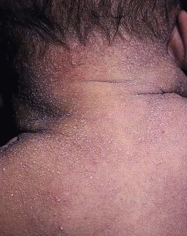 Figure 7.4, Tiny superficial vesicles seen on the back and neck of this newborn are characteristic of miliaria crystallina.