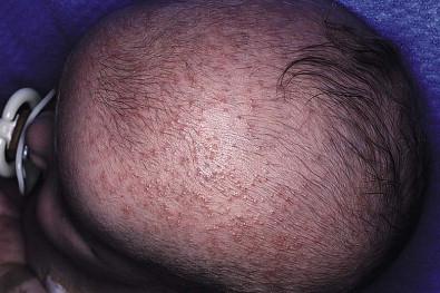 Figure 7.5, Inflammatory papules and/or pustules of miliaria rubra are nonfollicular in distribution and are seen here on the scalp of an overheated newborn infant.