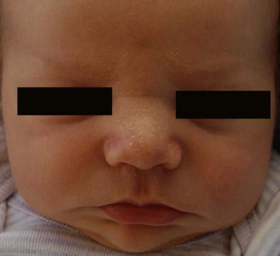 Figure 7.7, Sebaceous hyperplasia in a newborn.