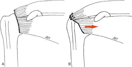 FIG. 14.1, Schematic illustration of a right shoulder demonstrating a subscapularis tendon tear left unrepaired. (A) Both the subscapularis and posterosuperior tendons are torn. (B) The subscapularis has been left unrepaired while the posterosuperior tendons have been repaired. There will be loss of the anterior cable attachment, thus producing additional strain that can lead to failure of the repaired posterosuperior tendons.