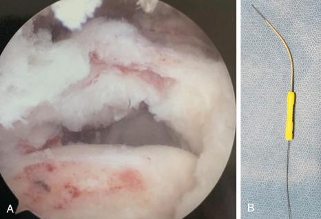 FIG. 14.11, (A) Arthroscopic view of a left shoulder demonstrating a delaminated tear that would be amenable to using a retrograde device for suture passage to help with providing equal tension of both muscle-tendon layers. (B) The Banana Lasso (Arthrex, Inc., Naples, FL) retrograde suture-passing device.