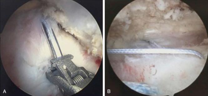 FIG. 14.14, (A) Arthroscopic view of the left shoulder through a lateral subacromial portal demonstrating the use of the Scorpion FastPass (Arthrex, Inc., Naples, FL) suture-passing device placed through the anterosuperolateral subacromial portal. The rotator cuff tendon is grasped, and the posterior grip is squeezed, allowing the nitinol needle to penetrate the tendon and advance the suture in an antegrade fashion. (B) Left shoulder view through an anterosuperolateral portal demonstrating retrieval of the suture loop.