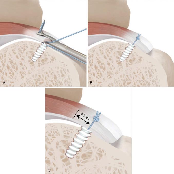 FIG. 14.15, (A) Schematic illustration of antegrade suture passage with a Scorpion suture passer (Arthrex, Inc., Naples, FL) used through a lateral working portal. Notice that the suture passes through the entire tendon at right angles to the tendon, assuring equal tension in all muscle-tendon segments from inferior to superior. (B) Following knot-tying, there is equal tension in the superior and inferior segments of the rotator cuff tendon. (C) Close-up view demonstrates the equal tension and the placement of the sutures 2–3 mm lateral to the musculotendinous junction (double-headed arrow demonstrates the distance necessary from the musculotendinous junction).