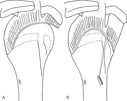 FIG. 14.2, Schematic illustration, demonstrated in (A) and (B), of a right shoulder demonstrating the repair of the anterior cable attachment. This links the supraspinatus and subscapularis tendons together, thus restoring balanced force couples and not only restoring the function of the subscapularis but also facilitating and reducing the strain on the repaired posterosuperior rotator cuff tendons.