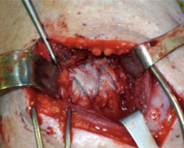 FIG. 14.3, Intraoperative photograph of a right shoulder demonstrating a mini-open rotator cuff repair.