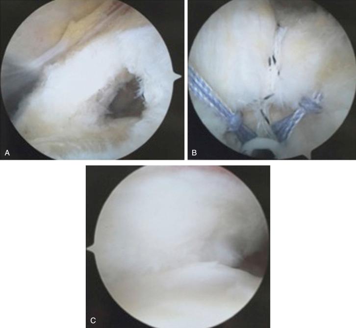 FIG. 14.4, Arthroscopic view of a left shoulder. (A) View from an anterosuperolateral subacromial portal of a small, nonretracted, mobile, crescent-shaped, single-tendon rotator cuff tear. (B) View from a lateral subacromial portal demonstrating a simple single row rotator cuff tendon repair. (C) View from a posterior glenohumeral portal demonstrating an anatomic restoration of the articular surface of the rotator cuff to its footprint.