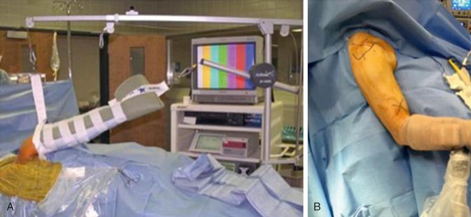 FIG. 14.5, (A) A patient in the lateral decubitus position for right shoulder surgery. (B) A patient in the beach chair position for right shoulder surgery.