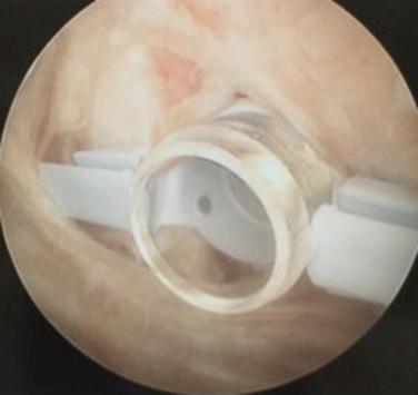 FIG. 14.7, Arthroscopic view of a right shoulder from a posterior subacromial portal demonstrating a Gemini 10-mm smooth subacromial cannula with distal cleats (Arthrex, Inc., Naples, FL) placed in the anterosuperolateral portal for ease of arthroscopic knot-tying.