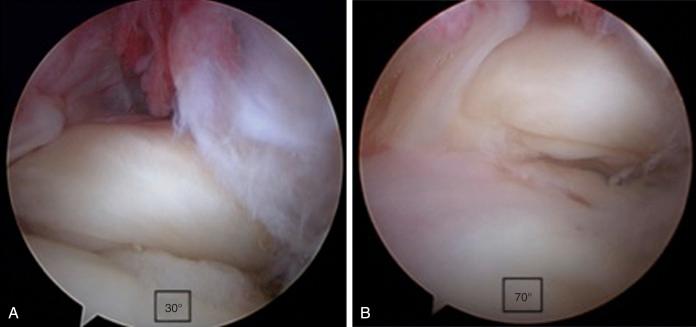 FIG. 14.8, Arthroscopic view of a left shoulder from a posterior glenohumeral portal demonstrating visualization of the subscapularis tendon footprint with (A) a 30-degree arthroscope and (B) a 70-degree arthroscope to “look around the corner” for better appreciation of a tear.