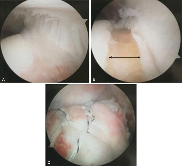 FIG. 14.9, Arthroscopic view of a right shoulder from a posterior glenohumeral portal using a 70-degree arthroscope demonstrating (A) a partial articular surface tendon avulsion lesion, (B) preparation with light decortication of the exposed footprint with a combination of arthroscopic burr and ringed curettes (double-headed arrow demonstrates the exposed and prepared footprint of the rotator cuff), and (C) arthroscopic view from a posterior subacromial portal of a transtendon rotator cuff double-row, double-pulley repair.