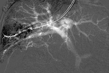 Figure 57-1, Wedged CO 2 hepatic venogram. CO 2 is injected through an occlusive balloon-tip catheter in the right hepatic vein, opacifying the portal system.