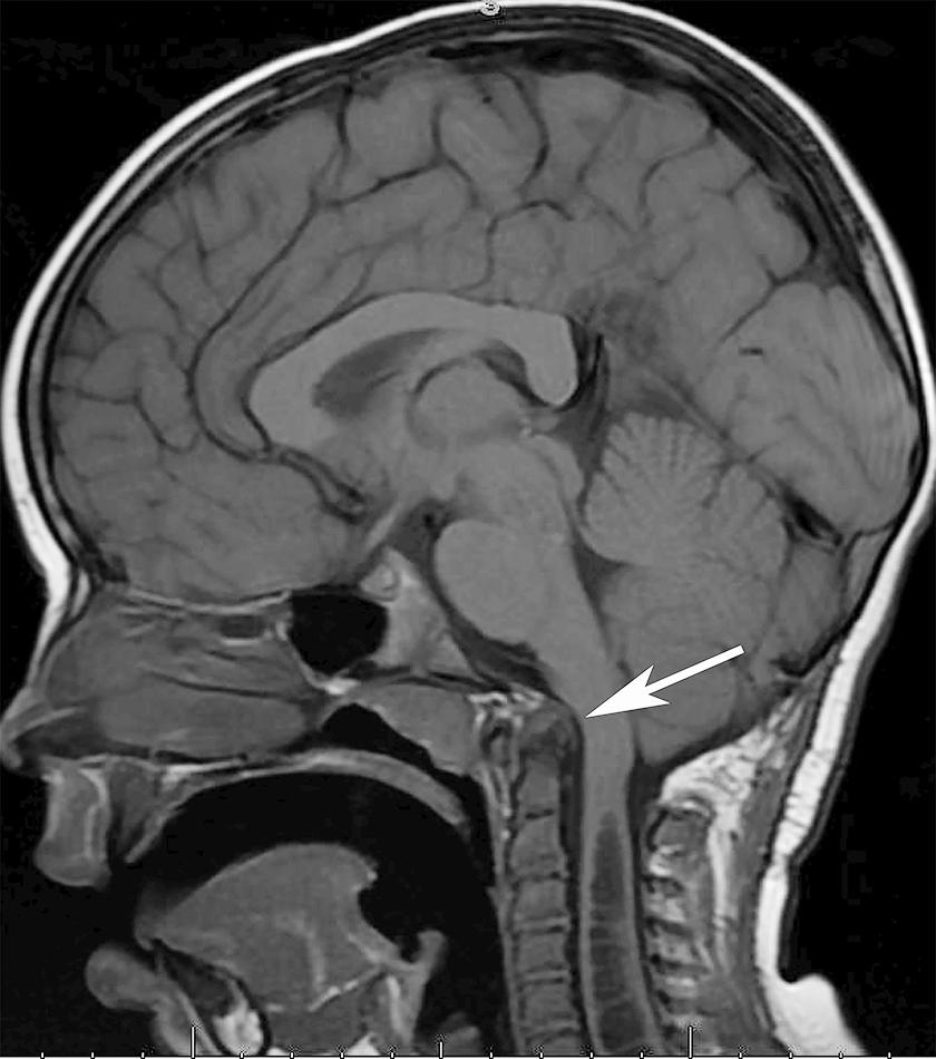 Fig. 123.1, Sagittal plane magnetic resonance imaging demonstrates basilar invagination and brainstem compression (arrow).