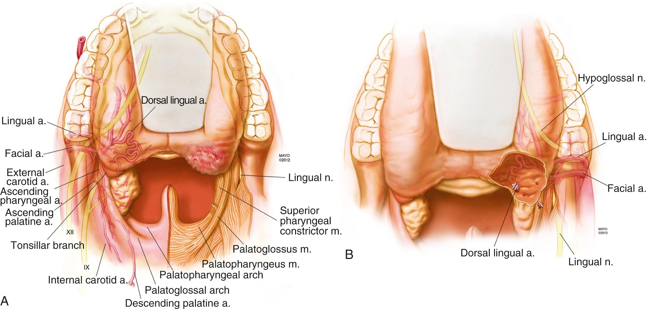 Fig. 97.3, (A) The arterial blood supply, innervation, and underlying musculature of the oropharynx as seen via a transoral perspective. (B) The anatomy of a tongue-base tumor after resection, highlighting two clips placed on the patient side of the dorsal lingual artery.