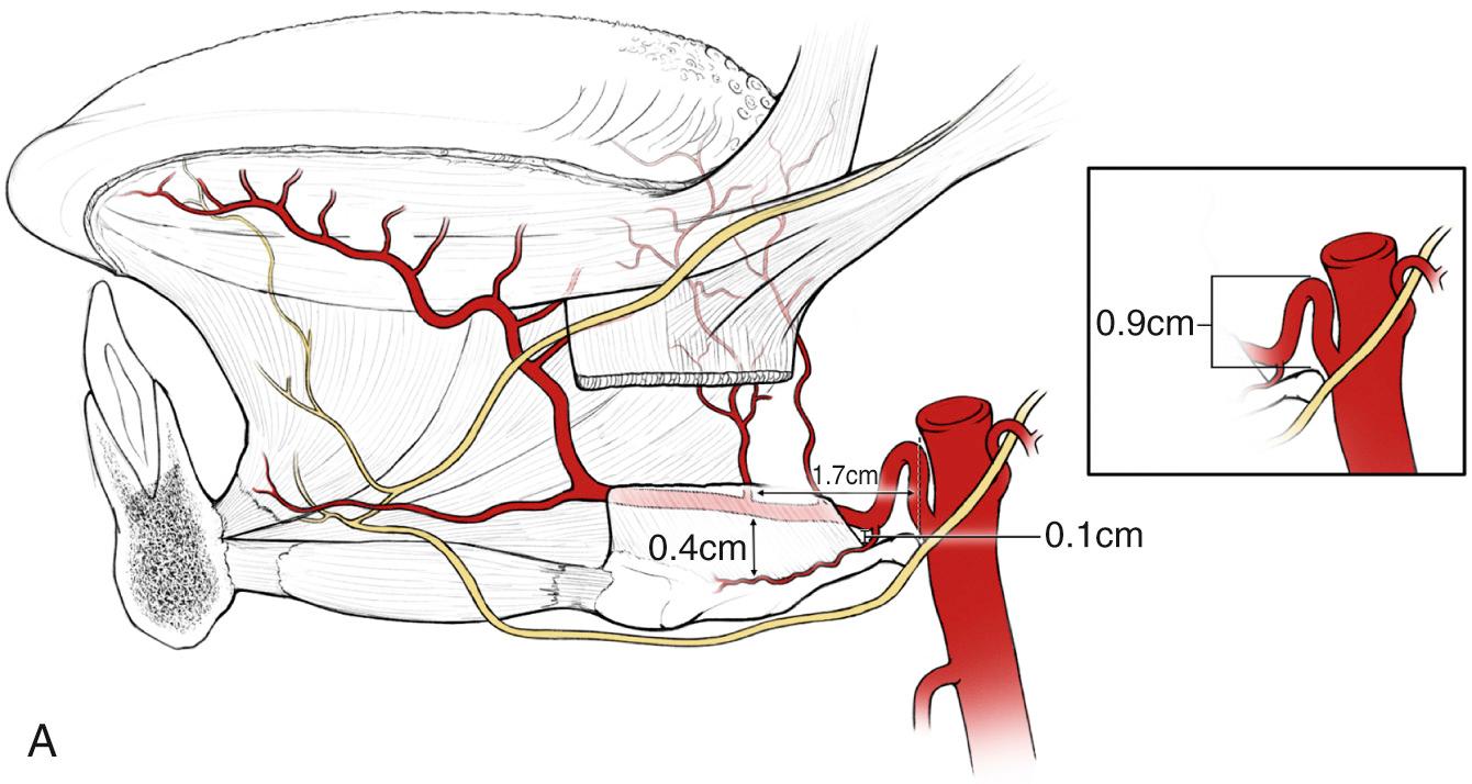 Fig. 97.4, (A) The arterial blood supply, innervation, and underlying musculature of the base of tongue. (B) The relationship of the lingual artery and its branches to identifiable tongue landmarks.