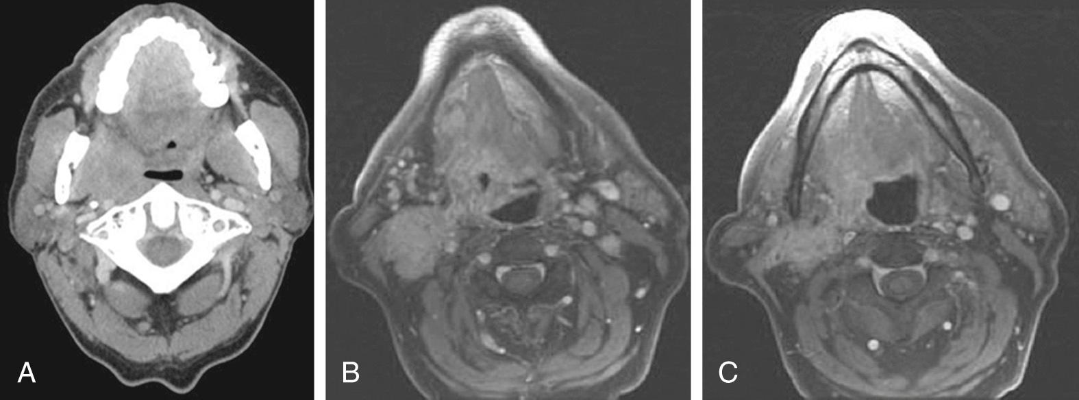 Fig. 97.6, (A) An unfavorable tonsil tumor invades into the masseteric space and effaces the internal carotid artery. (B and C) A very unfavorable tongue-base tumor that demonstrates deep invasion into the root of the base of the tongue that is also confluent with the neck disease.