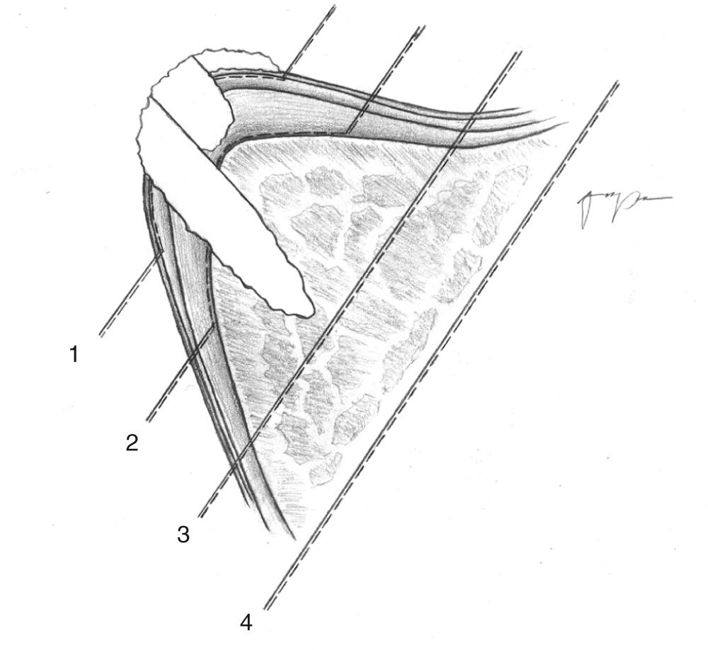 Fig. 107.1, European Laryngological Society cordectomy classification. 4