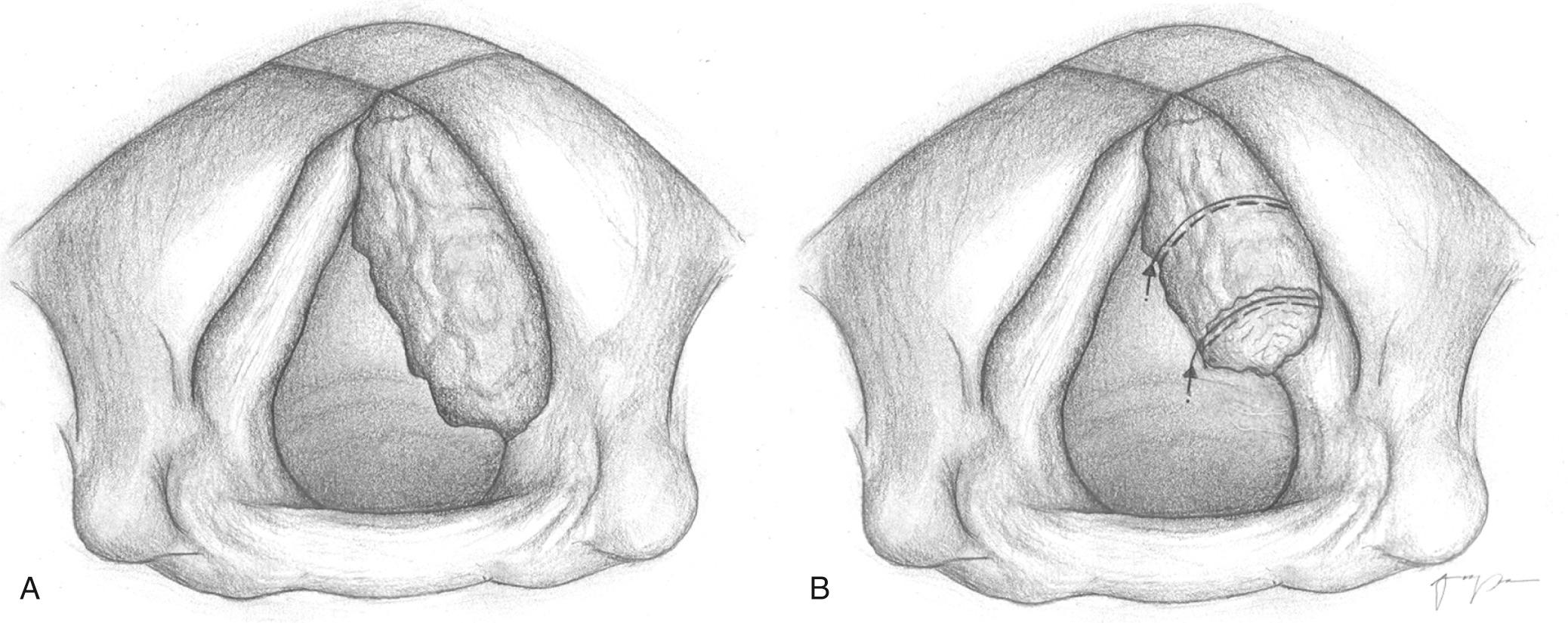 Fig. 107.2, Transoral laser microsurgical resection of glottic cancer.