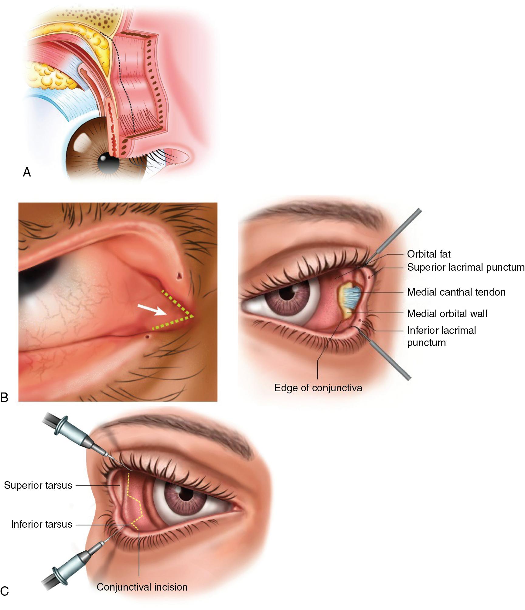 Fig. 36.1, Surgical incisions to superior, medial, and lateral orbital quadrants. A, The superior quadrant is accessed through a blepharoplasty approach, B, The medial quadrant is accessed via the precaruncular (transconjunctival) approach, C, The lateral retrocanthal (transconjunctival) approach.