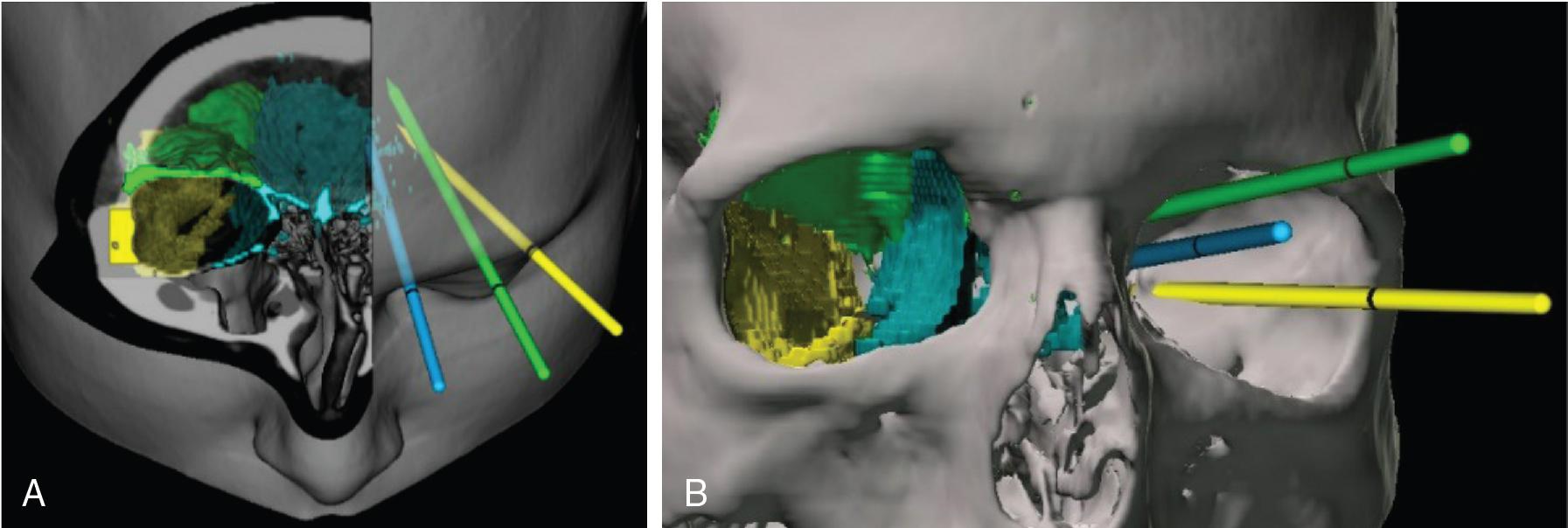 Fig. 36.2, Regions access through transorbital neuroendoscopic approaches. Precaruncular, blue ; superior lid crease, green ; and lateral retrocanthal, yellow . A, Color-matching regions accessed by corresponding endoscopic approaches, superior view. B, Anterior view demonstrates regions of the orbit that are accessed or passed through by corresponding approaches.