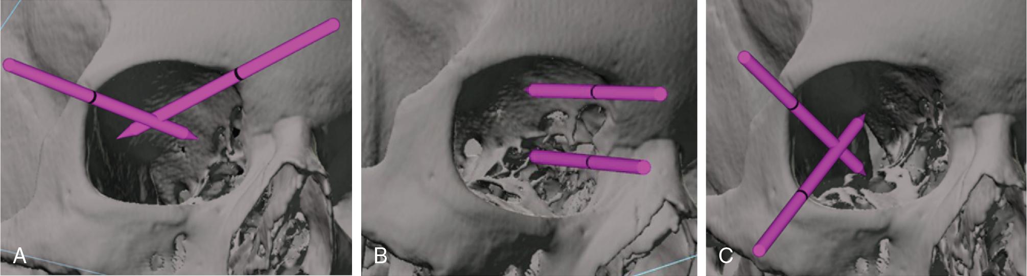 Fig. 36.3, Instrumentation through transorbital portals: superior ( A ), medial ( B ), and lateral ( C ). By varying instrumentation and visualization vectors, the entire quadrant of each approach can be reached. Note in B that the upper position accesses the intracranial portion of the interorbital anterior cranial fossa, and the lower position accesses the extracranial compartment.