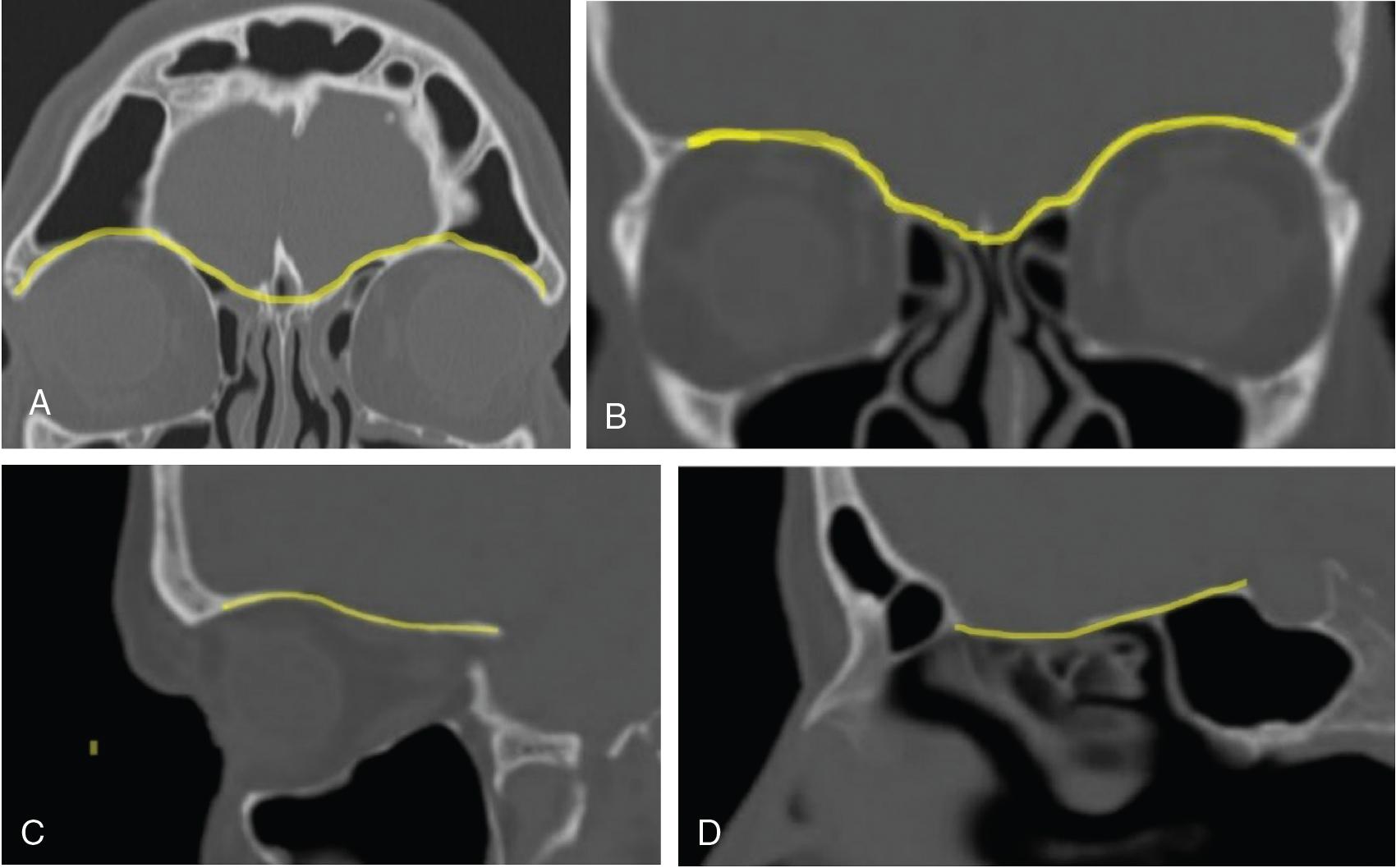 Fig. 36.4, Varying topography of the anterior cranial fossa (ACF): coronal ( A and B ) and sagittal (C and D) computed tomography scans. There is very significant variation in topography in the ACF. This variation is a key factor in choice of approach portal and pathway ( yellow highlights , ACF). As seen in A , whereas a superior eyelid crease approach may provide excellent access to the frontal sinus, the junction of the supraorbital and interorbital skull base in B may provide an excellent trajectory for access through a PC approach.