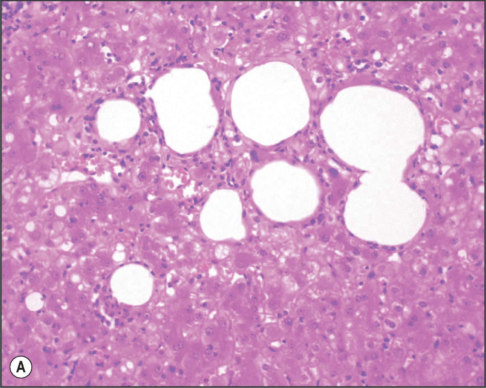 Figure 14.1, Lipopeliosis. Centrilobular fat microcysts are surrounded by macrophages in this biopsy specimen taken 10 days following insertion of a steatotic donor liver. Subsequent biopsy specimens have shown resorption of the fat with only minimal residual perisinusoidal fibrosis. (A, Haematoxylin and eosin [H&E]; B, immunostaining for CD68.)