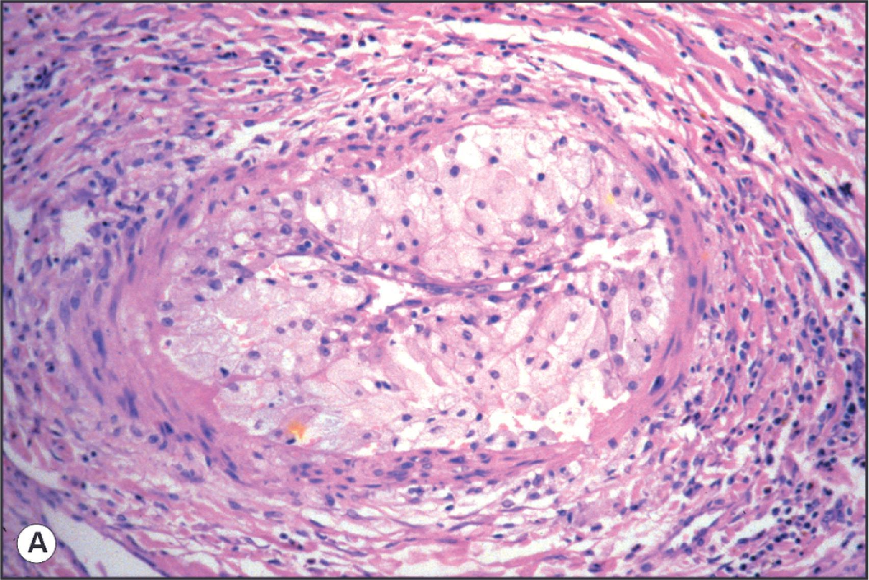 Figure 14.11, Arterial lesions in chronic rejection. (A) A medium-sized muscular artery contains an intimal foam cell lesion resulting in lumenal occlusion. (B) A medium-sized muscular artery shows prominent inflammatory infiltration involving all layers of the vessel wall. The majority of infiltrating cells are T lymphocytes. (C) Fibromuscular intimal thickening in chronic liver allograft rejection. These lesions are less commonly seen than intimal foam cell lesions. When present, they probably reflect longstanding damage. (D) Bisected liver allograft removed 4 months after transplantation. Occluded arterial branches stand up as yellow cords or nodules within large perihilar portal tracts. One well opened portal vein branch to the left shows yellow thickening of its wall. (A and B, H&E; C, Elastic haematoxylin van Gieson.)