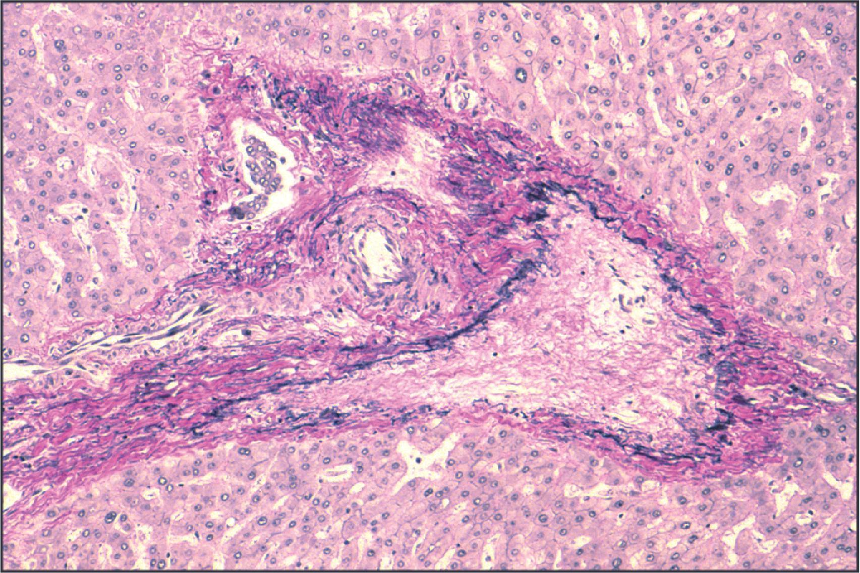 Figure 14.12, Portal veno-occlusive disease in chronic rejection. A portal vein branch shows occlusion by fibrous tissue. The presence of this lesion in combination with hepatic veno-occlusive lesions may be important in the pathogenesis of parenchymal fibrosis in chronic rejection. (Elastic haematoxylin van Gieson.)