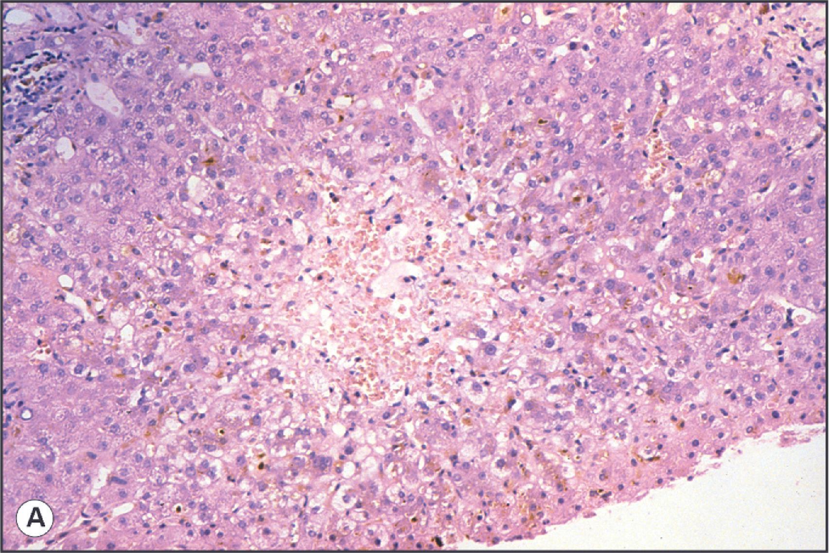 Figure 14.13, (A) Parenchymal damage in chronic rejection. There is an area of lytic necrosis involving acinar zone 3. Mild congestion is also present in this area along with severe cholestasis. (B) More extensive parenchymal damage with areas of bridging necrosis accompanied by a moderately dense infiltrate of inflammatory cells. (H&E.)