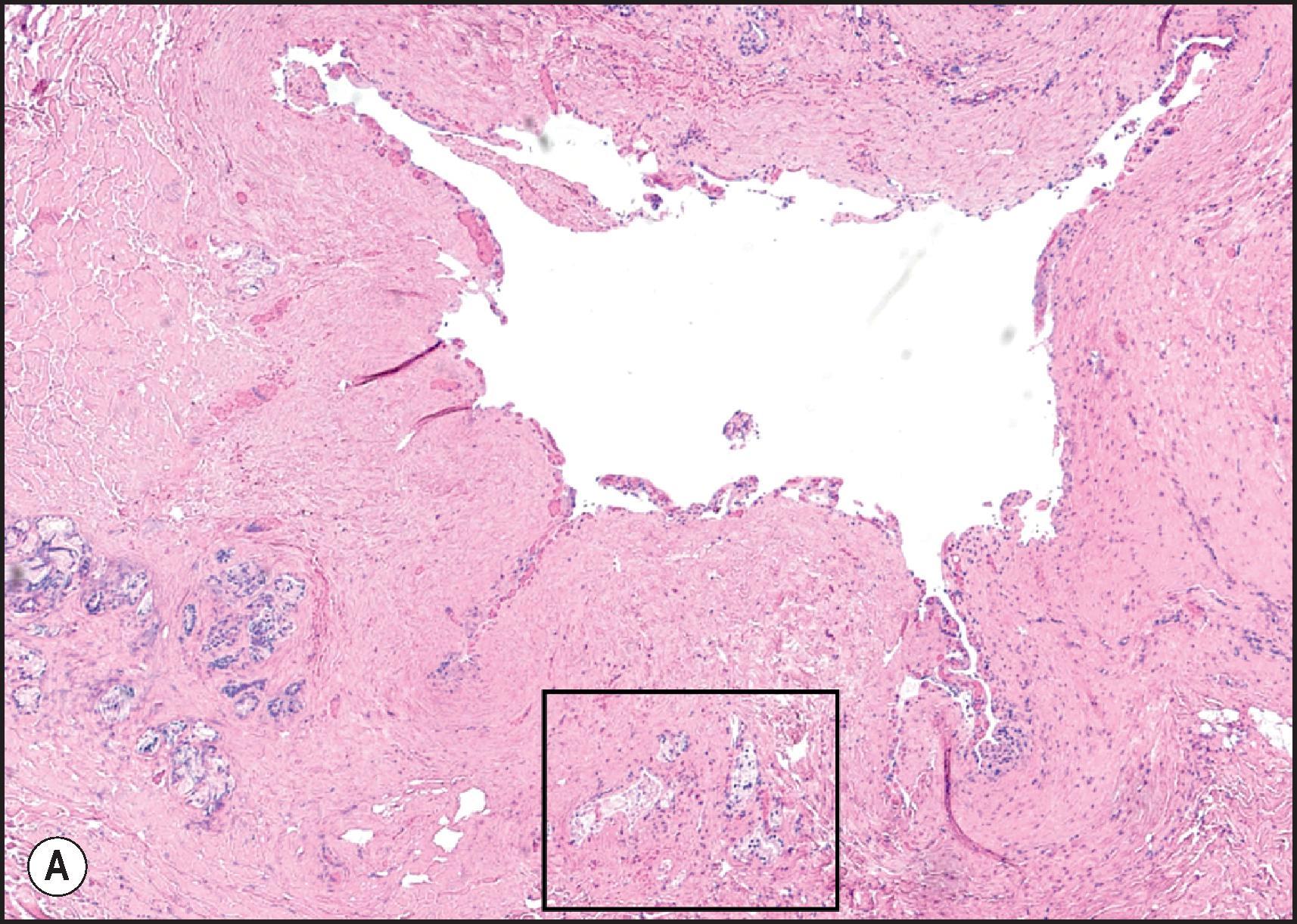 Figure 14.2, Ischaemic injury in donor bile duct. (A) Biopsy obtained from the donor bile duct prior to bile duct anastomosis shows complete loss of the lining epithelium and widespread loss of stromal nuclei in the duct wall. (B) Box from A—peribiliary glands show epithelial loss/detachment. (H&E.)