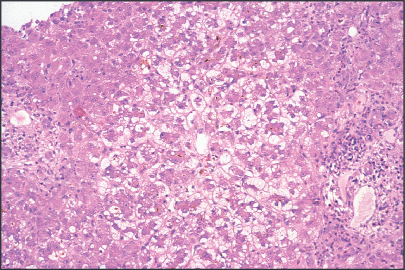 Figure 14.3, Preservation/reperfusion injury in liver allograft. This liver biopsy specimen, obtained 7 days post-transplantation, shows severe cholestasis and ballooning affecting centrilobular and midzonal hepatocytes. These changes are frequently seen in the absence of rejection and can be ascribed to preservation/reperfusion injury. (H&E.)