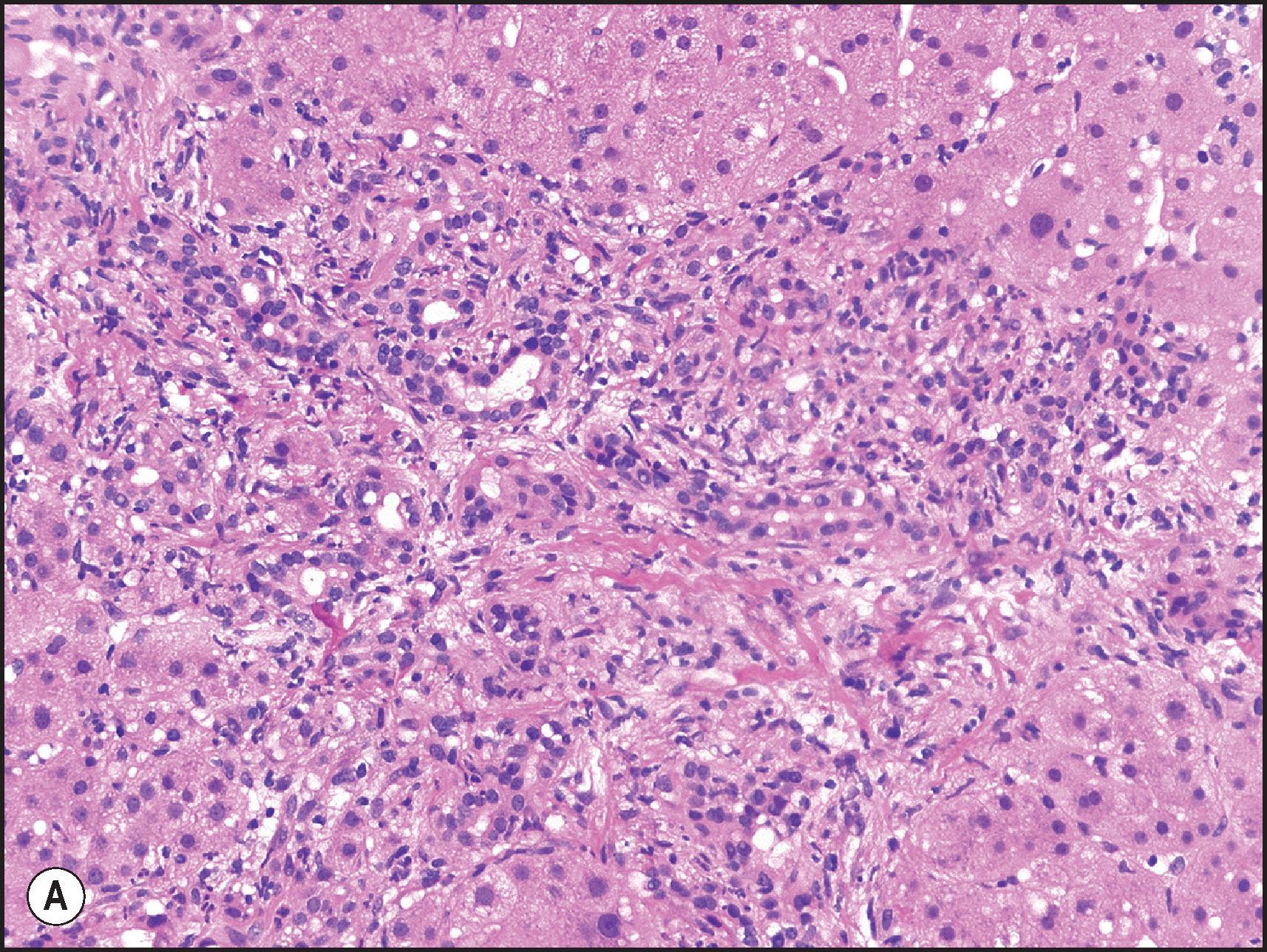 Figure 14.5, Acute antibody-mediated rejection. (A) Liver biopsy 13 days post-transplantation from a patient with a lymphocytotoxic positive crossmatch. Portal tract is oedematous with a mixed infiltrate of inflammatory cells. Marginal ductular reaction is also present. (B) Liver biopsy obtained 7 days following transplantation from another patient with worsening liver biochemistry and donor-specific antibodies to HLA-DQ. There is an eosinophil-rich portal inflammatory infiltrate, eosinophilic portal venulitis and portal vein endothelial hypertrophy. A small vessel at the edge of the portal tract shows microvasculitis (arrow) . (C) Immunostaining for C4d is positive in portal vessels, including a vessel showing microvasculitis (arrow) . (D) Immunostaining for C4d from another case of suspected antibody-mediated rejection shows sinusoidal C4d deposition with a mixed linear/granular pattern. (A, B, H&E; C, D, C4d immunoperoxidase.)