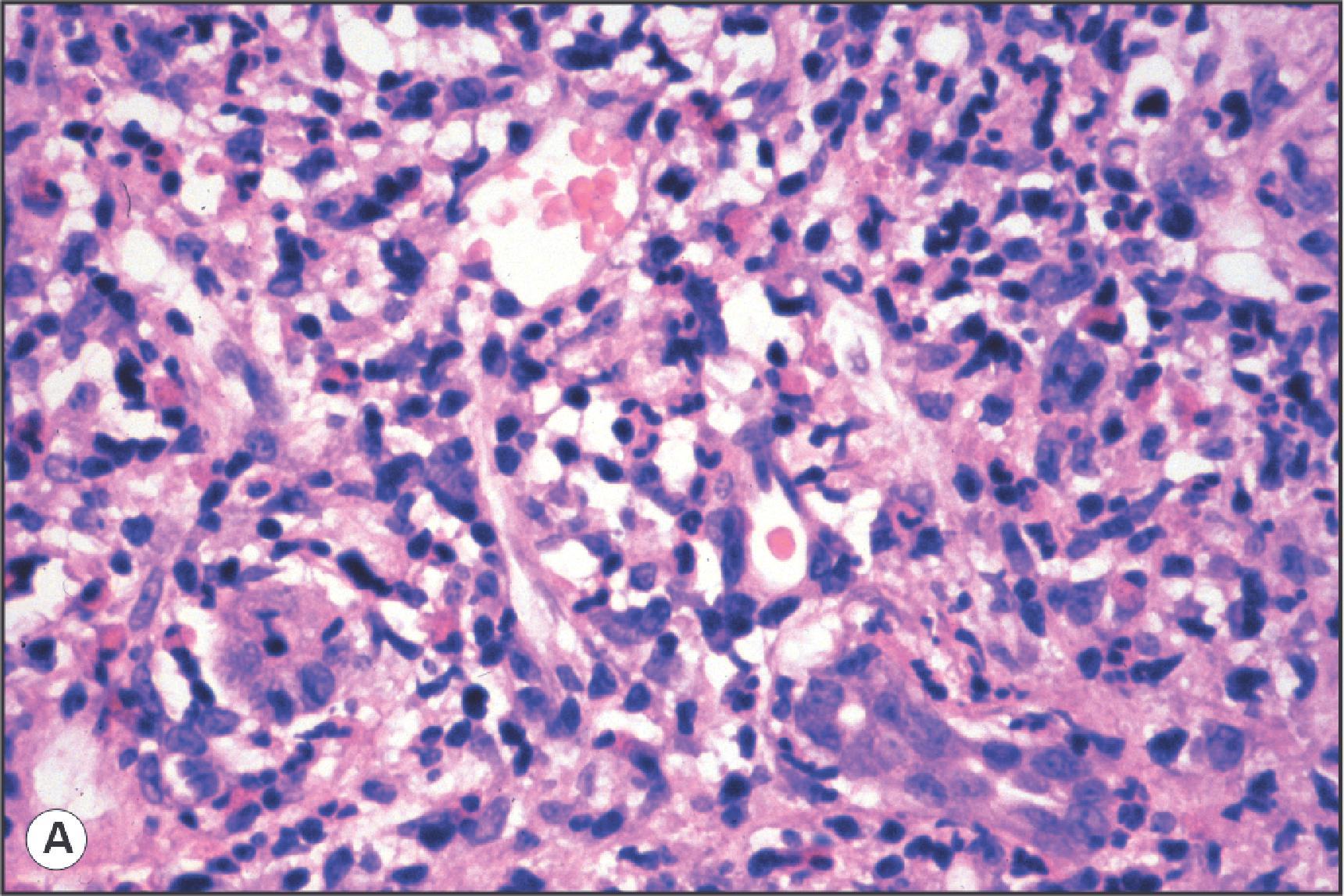 Figure 14.6, Portal tract lesions in T cell-mediated rejection (acute cellular rejection). (A) Portal tract contains a dense mixed inflammatory infiltrate including lymphocytes, blast cells, neutrophils and eosinophils. (B) An interlobular bile duct shows prominent inflammatory infiltration, mainly with neutrophils. (C) Portal venule shows subendothelial inflammatory infiltration associated with lifting and focal disruption of the endothelium. (D) Inflammatory infiltration of a small arterial branch. These changes are rarely seen in needle biopsy specimens. (H&E.)