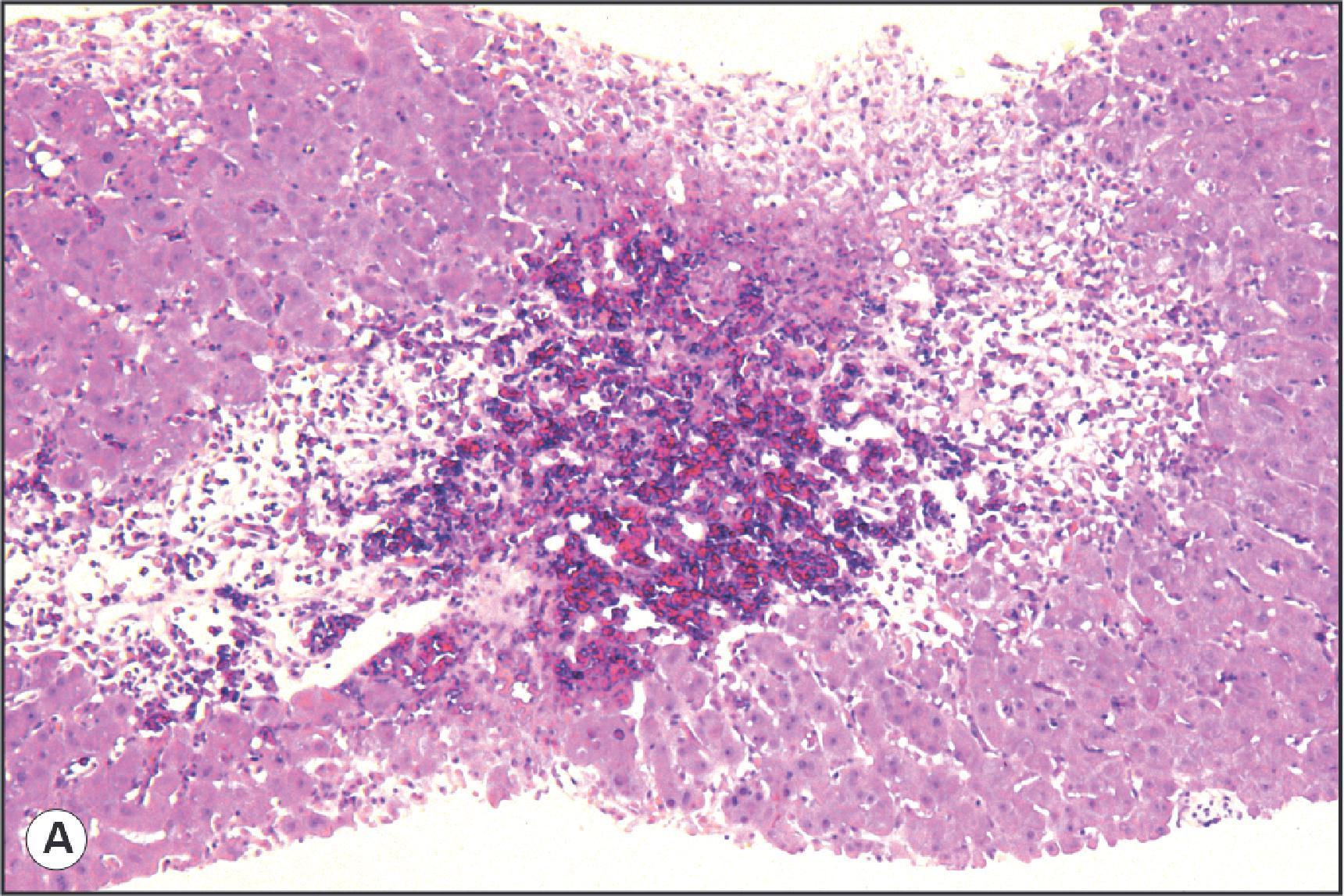 Figure 14.8, Rejection related veno-occlusive disease. (A) Severe congestion and hepatocyte loss are present in the centrilobular region, mimicking the changes seen in venous outflow obstruction. (H&E.) (B) Hepatic vein is occluded by a mixture of inflammatory cells and immature fibrous tissue. (Haematoxylin van Gieson.)