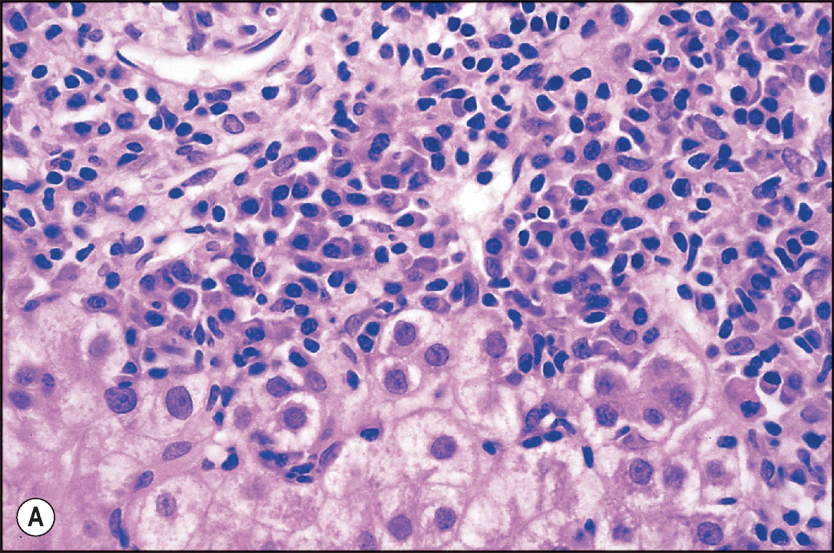Figure 14.9, Plasma cell-rich rejection. (A) Liver biopsy obtained 3.5 years after transplantation for primary sclerosing cholangitis and cholangiocarcinoma contains a dense plasma-cell rich portal inflammatory infiltrate associated with interface hepatitis. Serum anti-nuclear antibody (ANA) and anti-smooth muscle antibody (SMA) titres were 1:80 and 1:640, respectively. (H&E.) (B) In this biopsy obtained 7 months after transplantation for hepatitis B-related cirrhosis, there is a dense plasma cell-rich centrilobular inflammatory infiltrate associated with confluent/bridging necrosis. (H&E.)