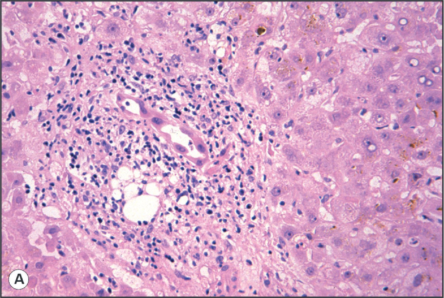 Figure 14.10, Bile duct lesions in chronic rejection. (A) Early chronic rejection. Liver biopsy obtained 5 months post-transplantation following unsuccessful treatment of an acute rejection episode. An interlobular bile duct shows nuclear pleomorphism and disordered polarity, producing a ‘dysplastic’ appearance. (H&E.) (B) Late-stage chronic rejection. Portal tract has a characteristic ‘burnt-out’ appearance with no recognizable bile duct branch. Only mild inflammatory changes are present. There is no obvious ductular reaction. (H&E.) (C) Large bile duct lesion in end-stage chronic rejection. In this hepatectomy specimen obtained at retransplantation, the lumen of a large bile duct is occluded by immature fibrous tissue. No residual biliary epithelium is identified. (Haematoxylin Van Gieson.) (D) Keratin 7 immunostaining confirms bile duct loss and the absence of a ductular reaction. Numerous K7-positive cells with an intermediate hepato-biliary phenotype are present in the periportal region. P , Portal tract.