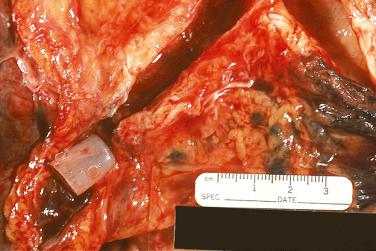 FIG. 24.1, Stenotic bronchial anastomosis. Gross photograph, at autopsy, of bronchial anastomosis with stenosis, status post stent placement. Careful dissection is needed to document correct placement.