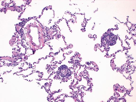 FIG. 24.4, Mild acute rejection. Multiple foci of mild perivascular infiltrates (grade A2) are seen at low power.