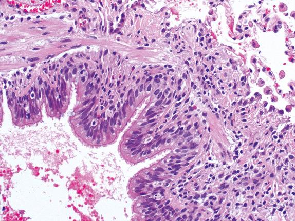 FIG. 24.6, Low-grade lymphocytic bronchiolitis. There is a bandlike inflammatory infiltrate in the bronchiolar submucosa (grade B2/B1R).