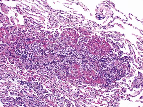 FIG. 24.7, Moderate acute rejection. This example shows perivascular infiltration with endothelialitis (subendothelial infiltrates associated with endothelial swelling and sloughing) and extension of inflammation into adjacent alveolar septa and fibrin (grade A3).