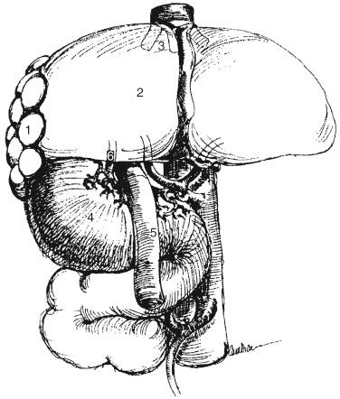 FIGURE 67-1, Commonly associated anomalies found in patients with biliary atresia and situs inversus include multiple spleens or asplenia (1) , transverse liver (2) , interrupted inferior vena cava (3) , situs inversus or malrotation of the intestine (4) , preduodenal portal vein (5) , and aberrant hepatic arterial inflow (6) .