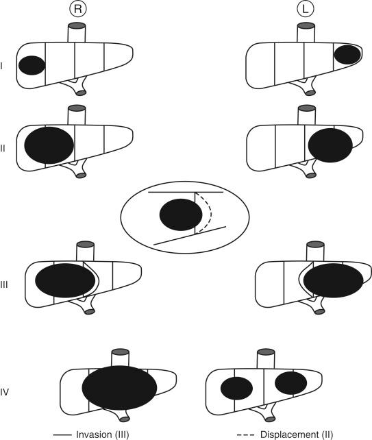 FIGURE 28-1, SIOPEL (International Childhood Liver Tumours Strategy Group) pretreatment extent of disease (PRETEXT).