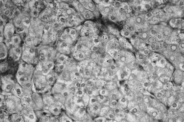 FIGURE 27-1, α 1 -Antitrypsin deficiency. In a periodic acid–Schiff–stained section of the liver after diastase, pink, diastase-resistant globules of α 1 -antitrypsin are apparent within hepatocytes, particularly in the periportal area. Fibrosis in the portal triad is also evident.