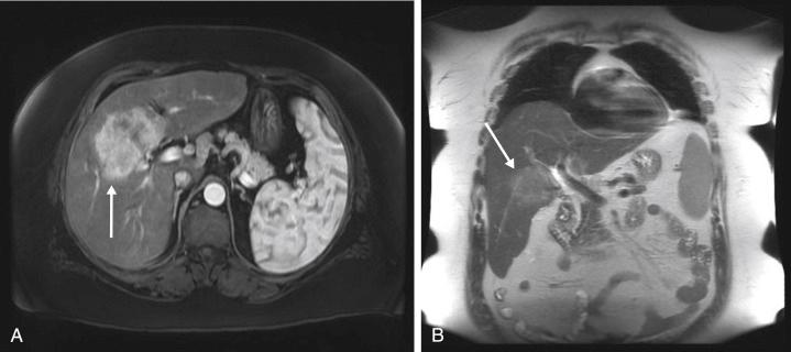 FIGURE 16-1, Magnetic resonance evaluation with T1-weighted, contrast-enhanced, fat-suppressed axial image ( A ) and T1-weighted coronal image ( B ) accurately depict the size and precise location of central hepatocellular carcinoma (arrows) .
