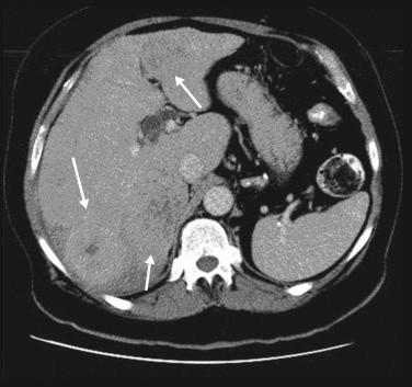 FIGURE 16-2, Contrast-enhanced computed tomography demonstrates typical enhancement pattern in a patient with multifocal hepatocellular carcinoma (arrows) .