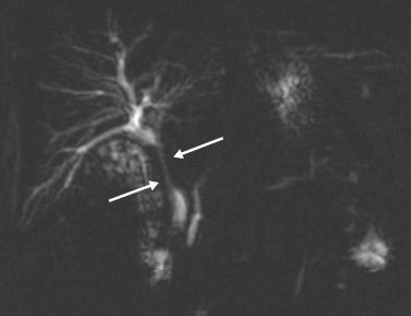 FIGURE 16-3, Magnetic resonance cholangiopancreatography demonstrates malignant long-segment narrowing of the common bile duct (arrows) in a patient with central cholangiocarcinoma.