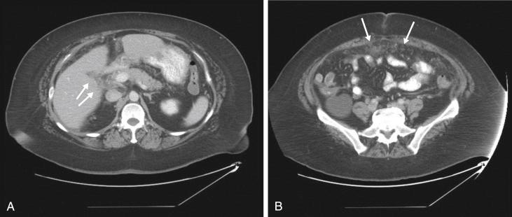 FIGURE 16-4, Computed tomography demonstrates vague soft tissue density in the hepatic hilum surrounding the common bile duct ( A ; arrows ) and omental caking ( B ; arrows ) in a patient with cholangiocarcinoma presenting with peritoneal carcinomatosis.