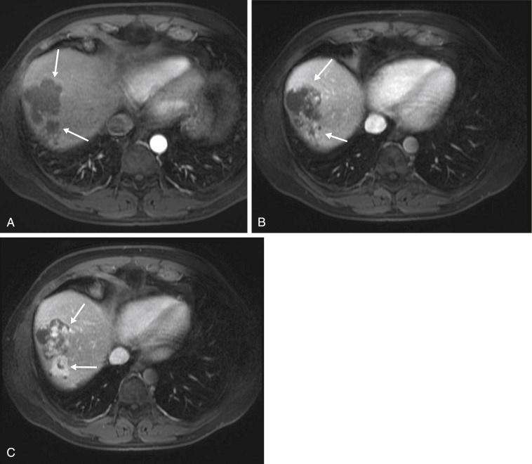 FIGURE 16-5, Contrast-enhanced magnetic resonance evaluation demonstrates typical enhancement pattern of cavernous hemangioma. Lobulated contour and peripheral, nodular, or cloudlike enhancement ( A ; arrows ) associated with progressive centripetal filling of the lesion ( B and C ; arrows ) confirm cavernous hemangioma.