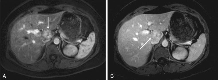 FIGURE 16-6, Contrast-enhanced magnetic resonance imaging demonstrates a typical appearance of focal nodular hyperplasia. This lesion is nearly isointense to hepatic parenchyma, often demonstrates central nidus ( A; arrow ), and shows arterial-phase contrast enhancement ( B ; arrow ).